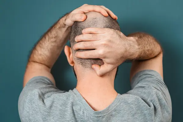 Alopecia Areata: Tudo o que Você Precisa Saber Sobre a Queda de Cabelo Autoimune